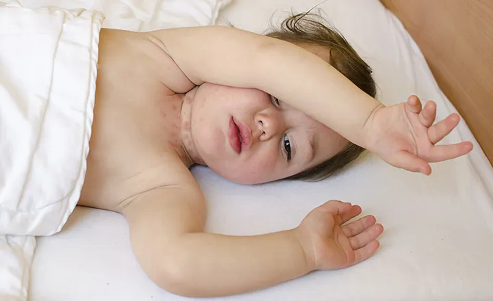 Bé bị hăm cổ
