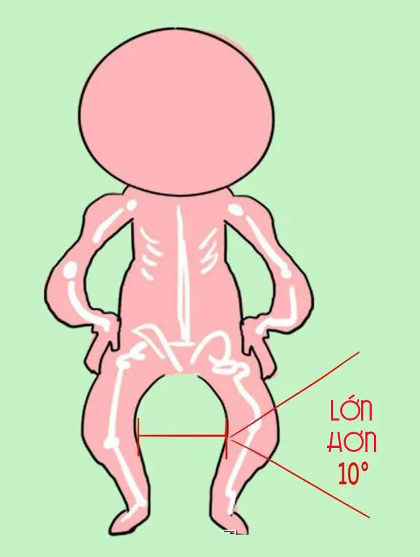 Đưa bé đi khám bác sĩ khi bị chân vòng kiềng nặng