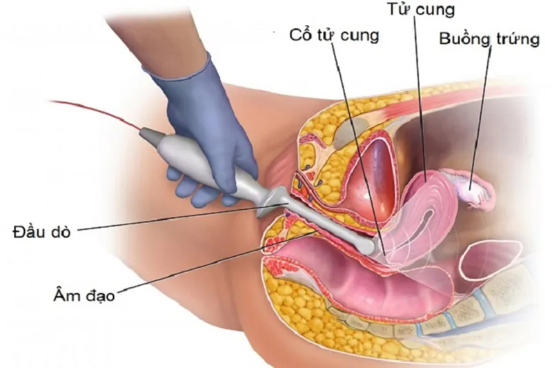 Hình ảnh bác sĩ thực hiện siêu âm đầu dò