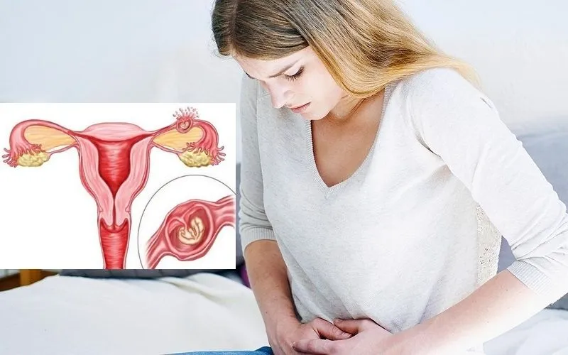 Hình ảnh minh họa về sự nguy hiểm của thai ngoài tử cung