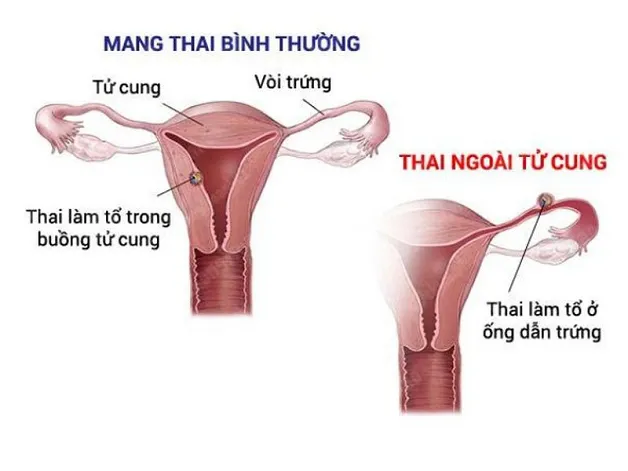 Mô tả hình ảnh siêu âm thai ngoài tử cung