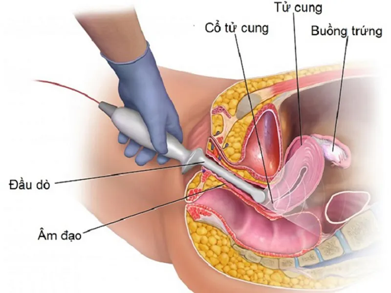 Siêu âm đầu dò cho bà bầu